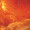 Retinal Detachment